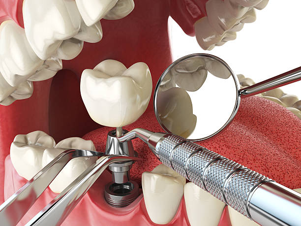 Best Emergency Dental Care for Broken or Chipped Teeth in Bassett, VA
